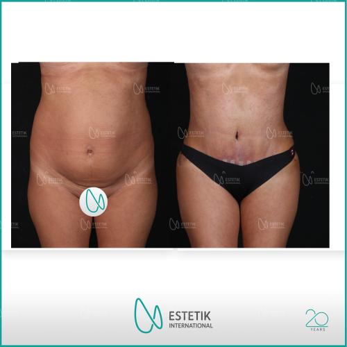 Before after photos of our patients 7